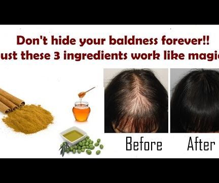 Don't Live With Baldness Forever! Just 3 Ingredients Is All You Need!!
