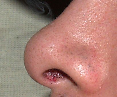 Blackheads on Nose Symptoms and Causes