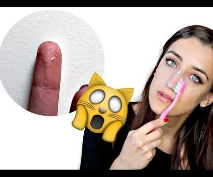 HOW TO REMOVE ALL BLACKHEADS!