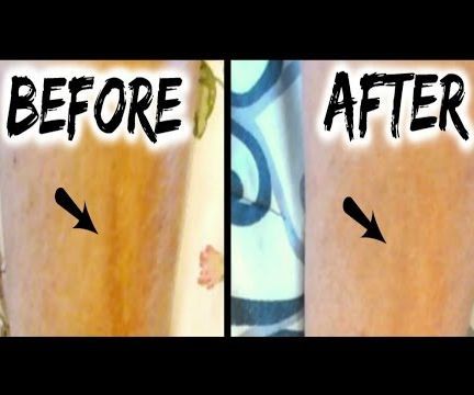 Mederma Advanced Scar Gel Review & Results L Scar Before & After