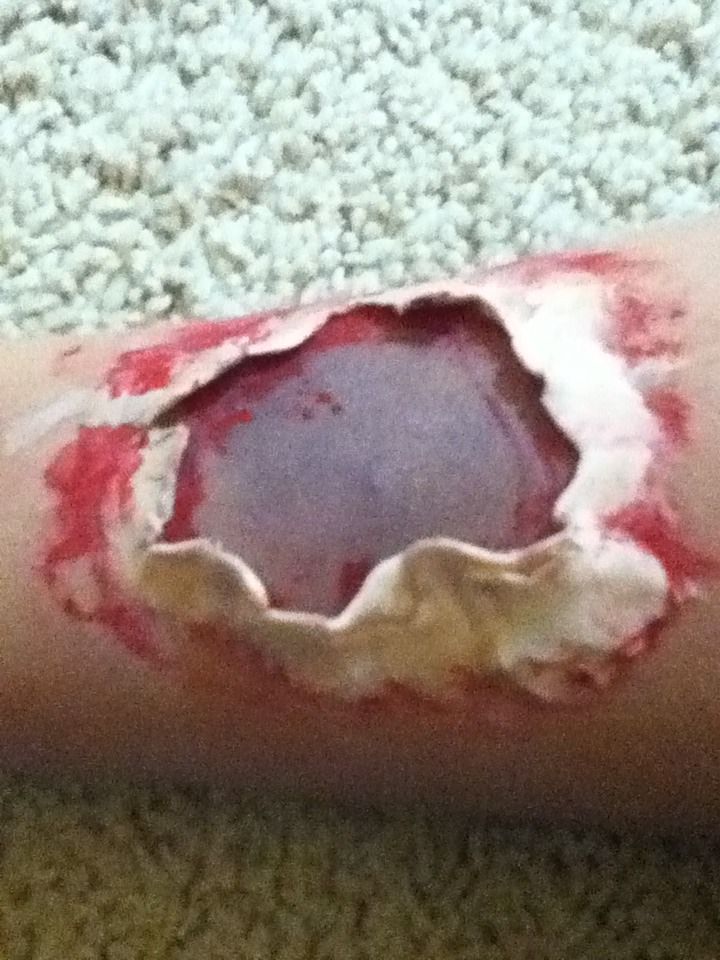 Zombie Wound