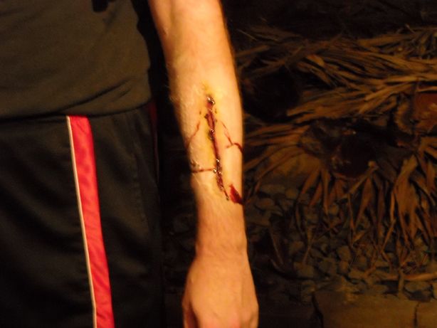 Gelatin wounds.