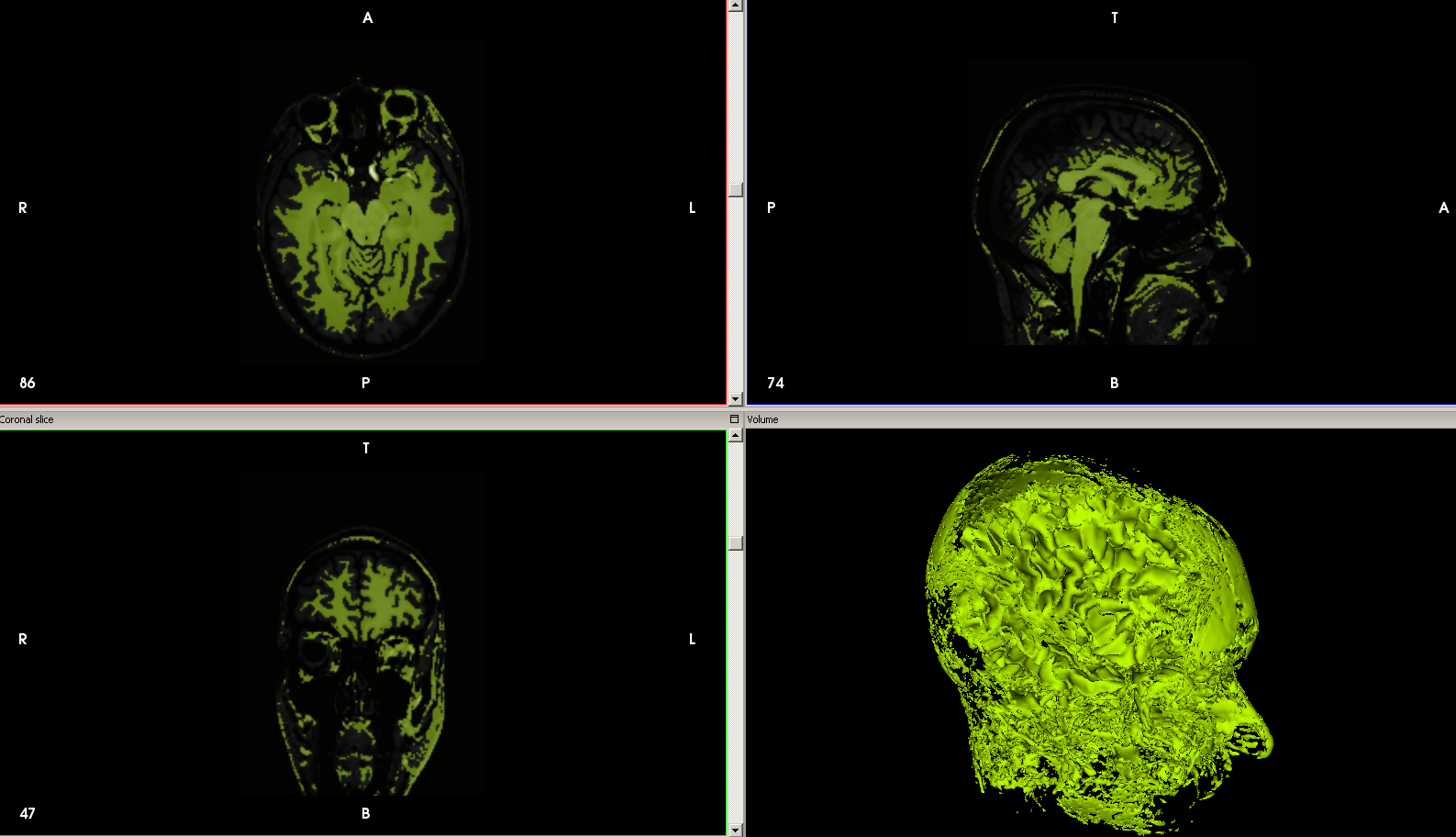 Edible Chocolate Brain From MRI Scan : 9 Steps (with Pictures ...