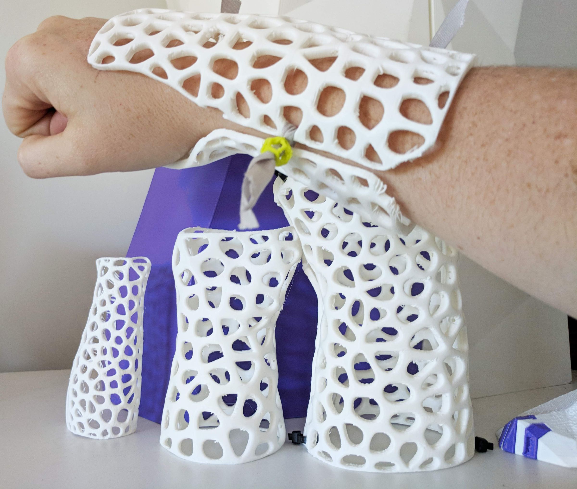 How to Design Custom, 3D Printable Braces for Arm Injury : 8 Steps ...