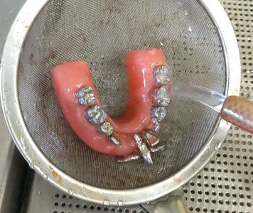 Remove Metal Teeth