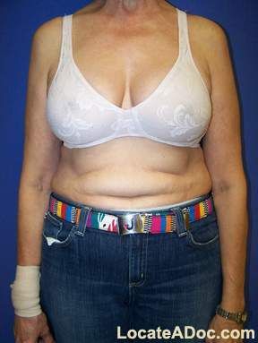 Breast Implant and Their Procedure
