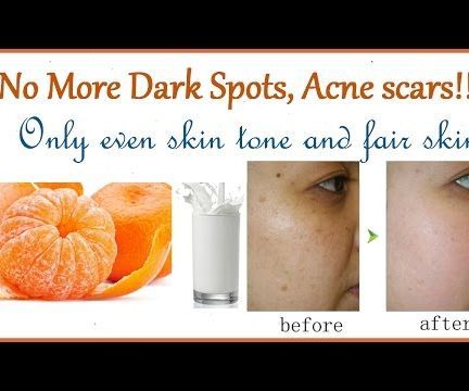 No More Dark Spots, Acne Scars:This Mask Removes Them All!!