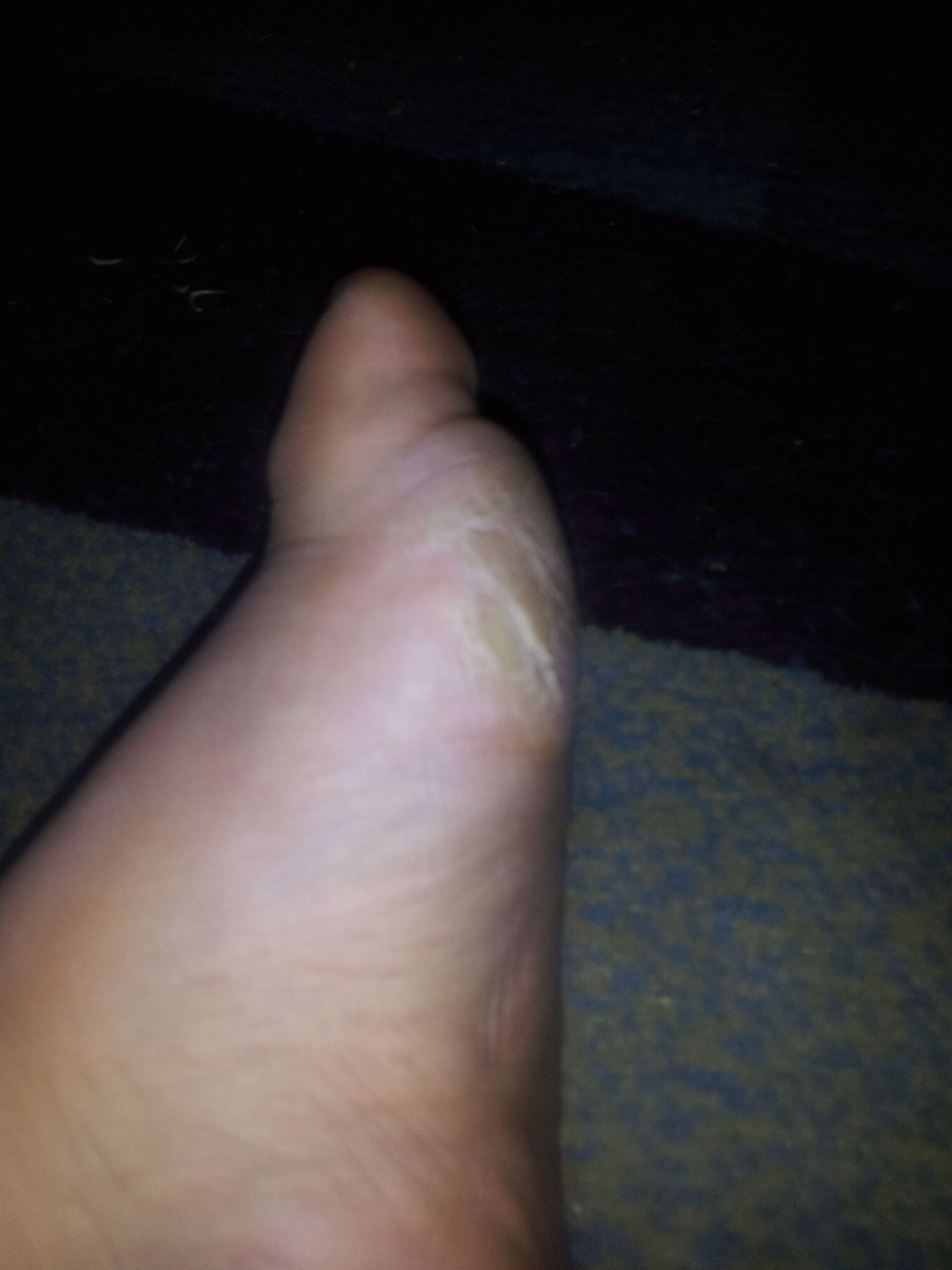 Treating rough, dry, cracked and calloused feet.