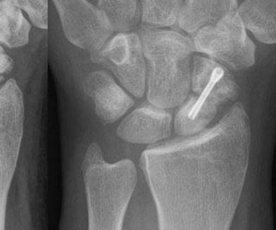 Strong Repair Almost Any Broken Plastic