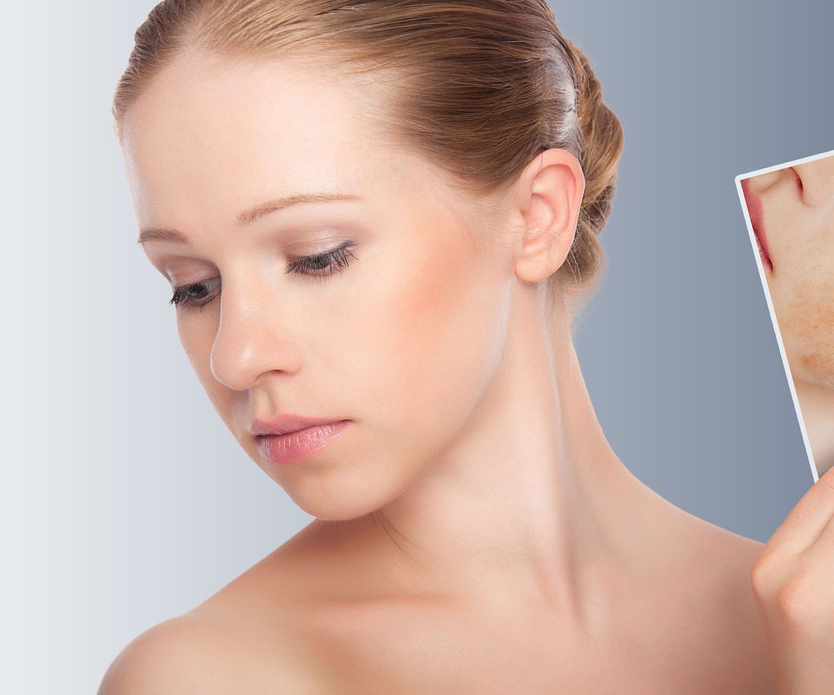 Acne the Top Acne Treatment.