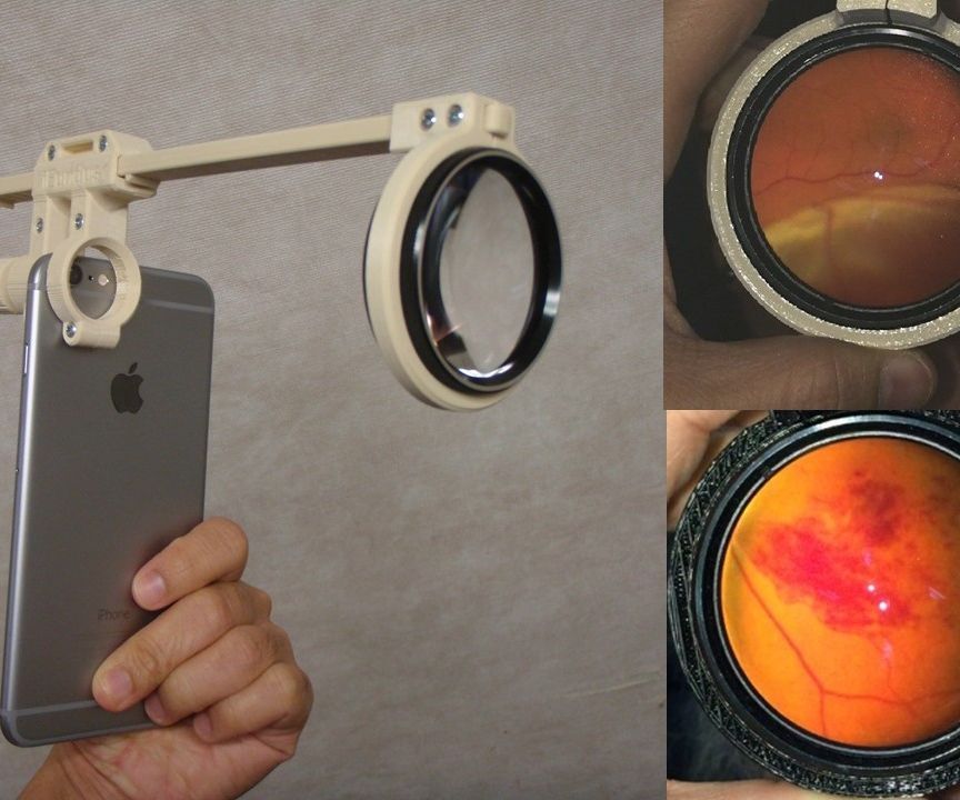 Smartphone Ophthalmoscope ODocs Fundus