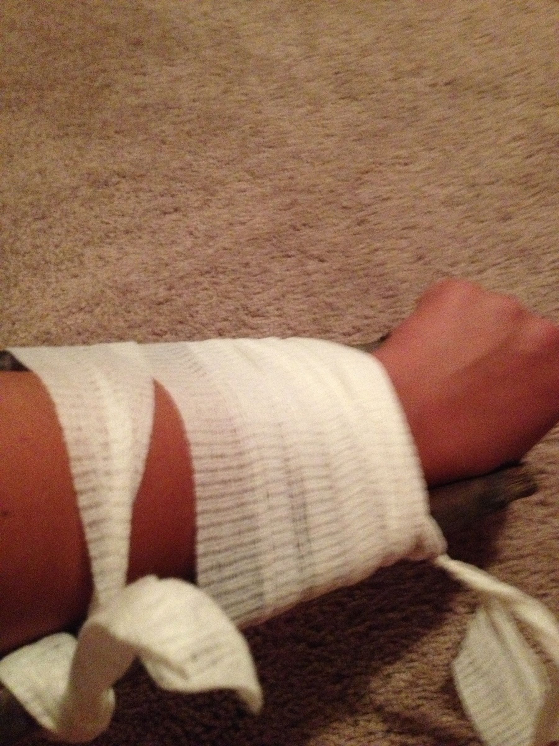 How to Make a Splint/ Fix a Broken Bone