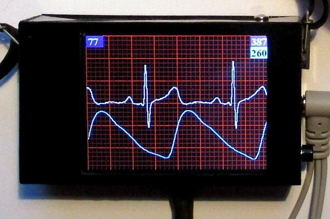 ECG With PPG Using Arduino : 9 Steps (with Pictures) - Instructables