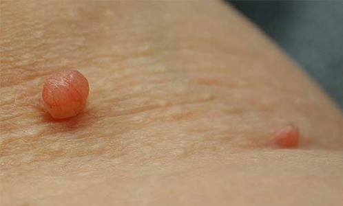 Skin Tags: Defined, Cause, and Removal.