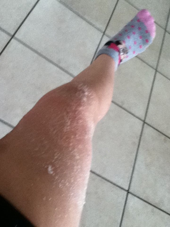 How to Get  Mosquito Bites Not to Itch Without Using Cream