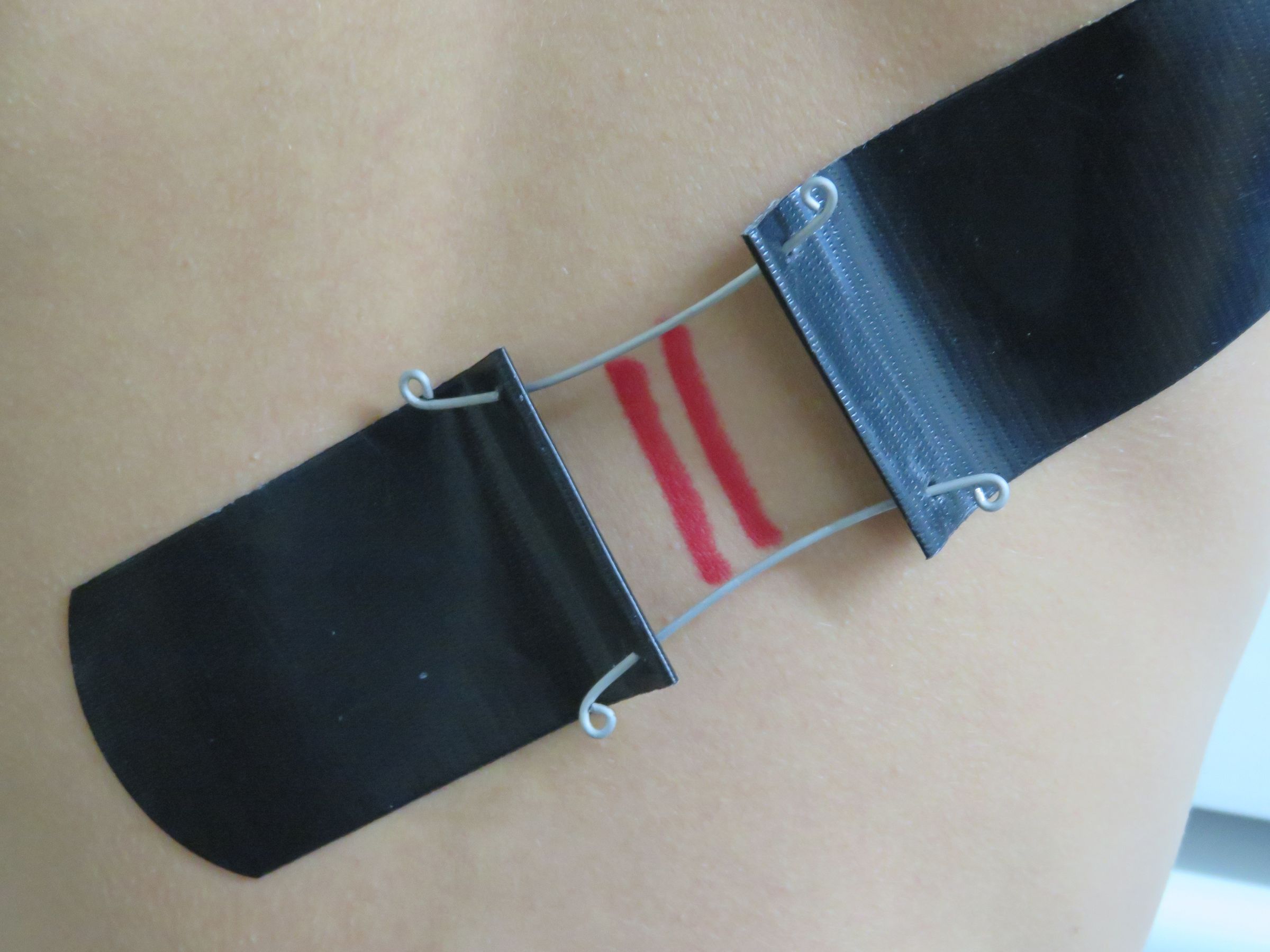 Montgomery Straps For Wounds