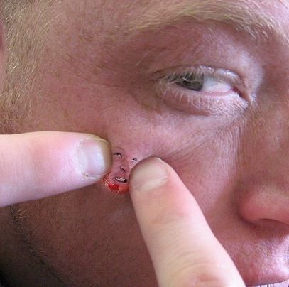 How to Prevent Pimples and Reduce Acne Naturally by Eating Right