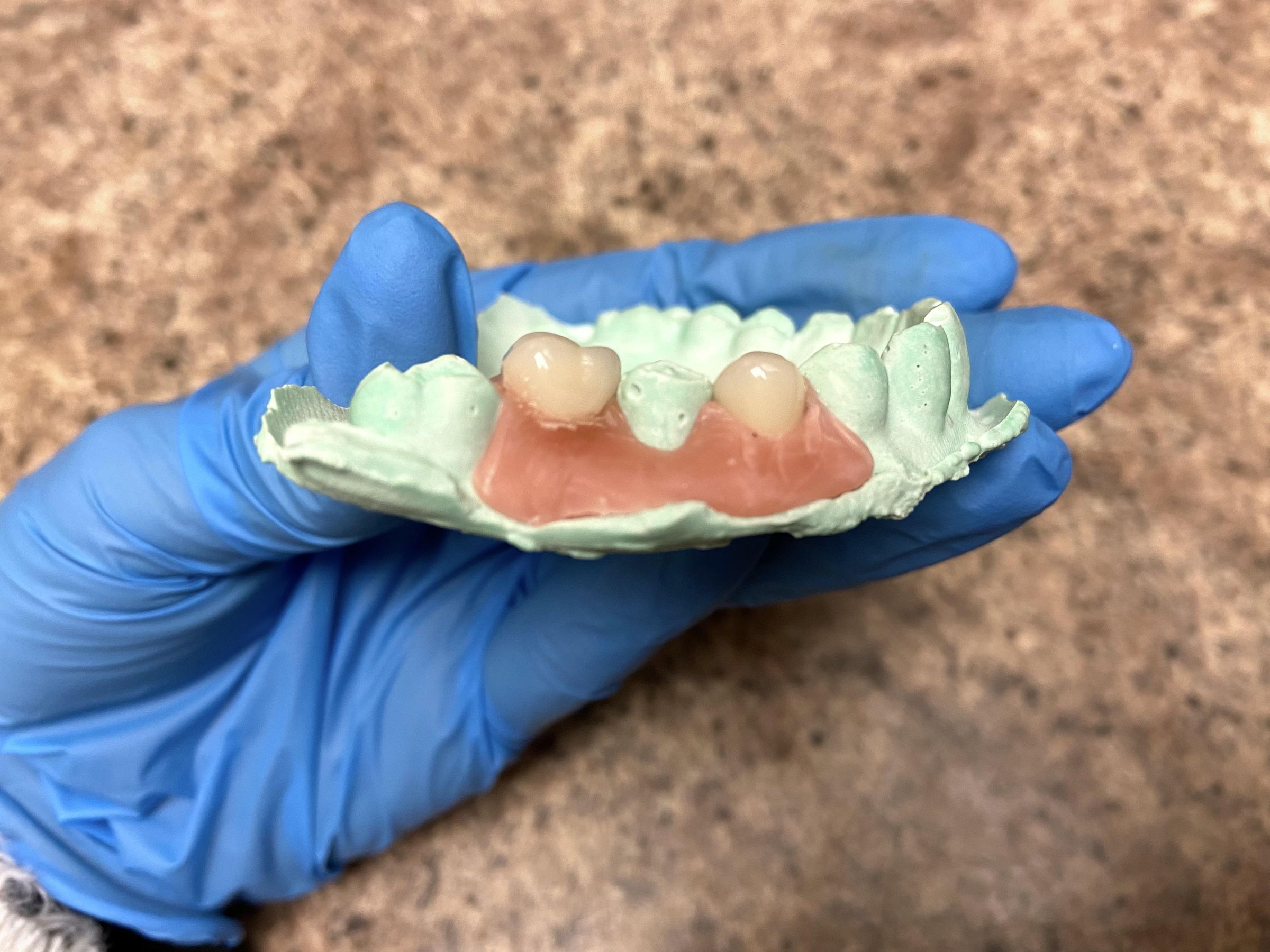DIY Dentures / Temporary Tooth 6 Steps Instructables
