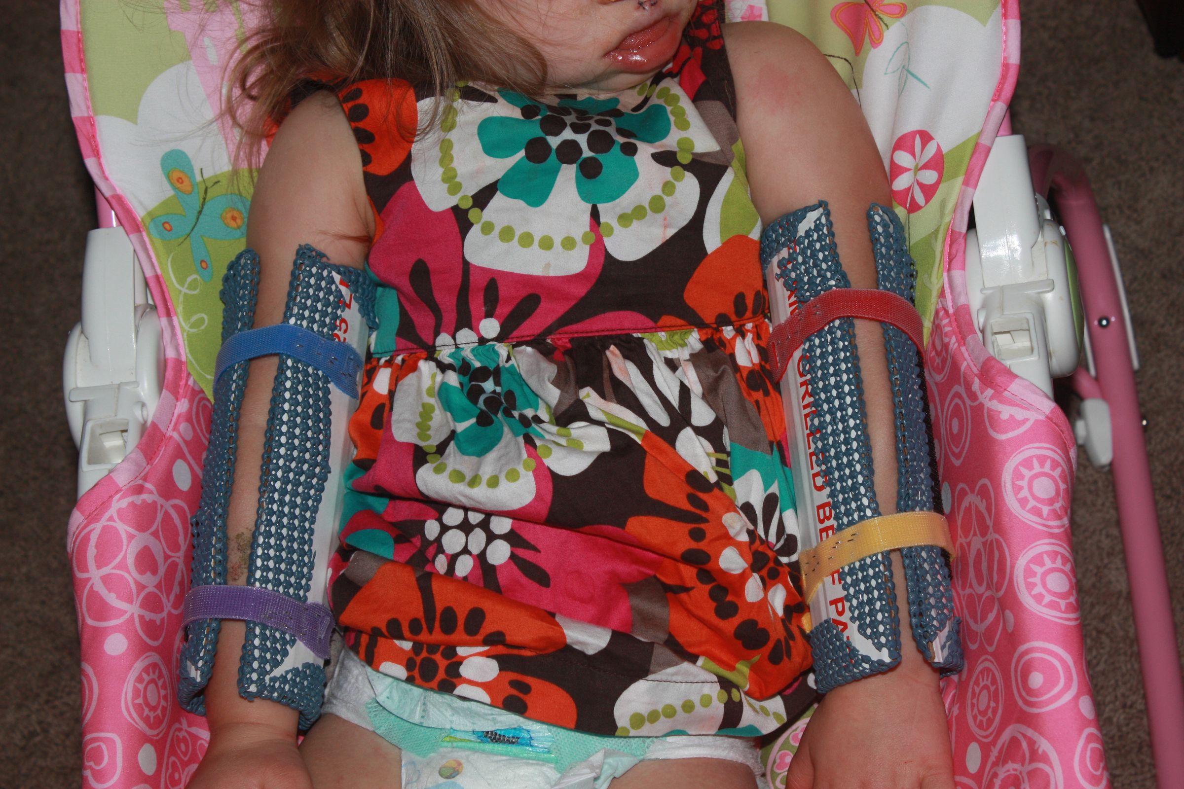 Arm Immobilizers ('No-Nos', Pediatric Immobilizers)