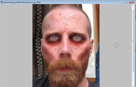 Step Five: Thrombosis, or Blood Clotted Veins.