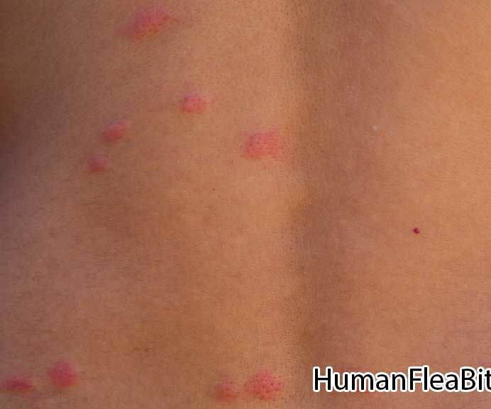 Major Thing You Must Know About Fleabites & Best Treatment