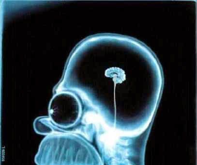 3D Printing From MRI Data in 5 Steps 