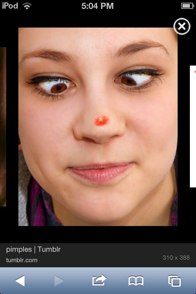 How to Get Rid of Pimples!