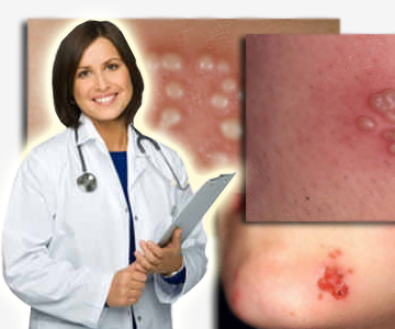 ​Symptoms, Diagnosis and Treatment of Genital Herpes -  Ultimate Herpes Protocol