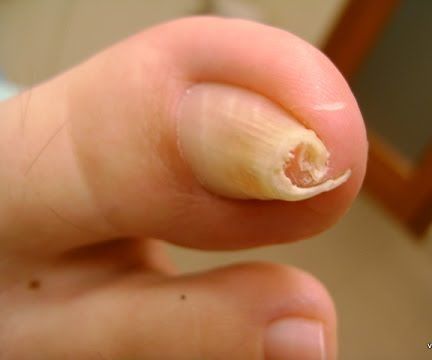 Treatment of Toenail Fungus