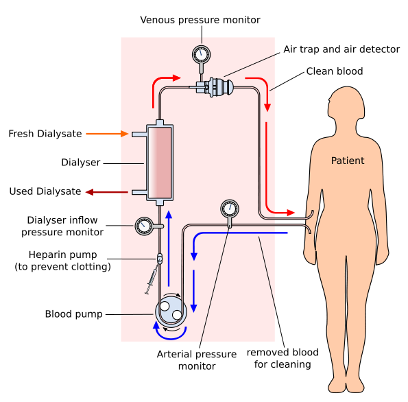 Pros and Cons of Peritoneal Dialysis
