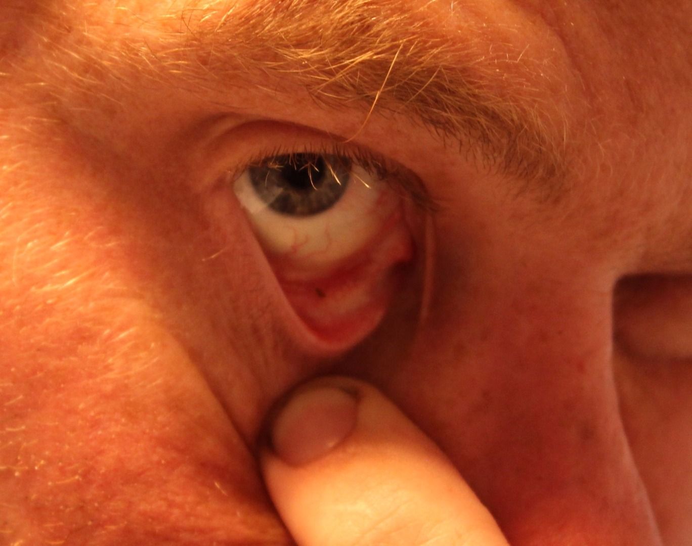 Wood Splinter In Eye