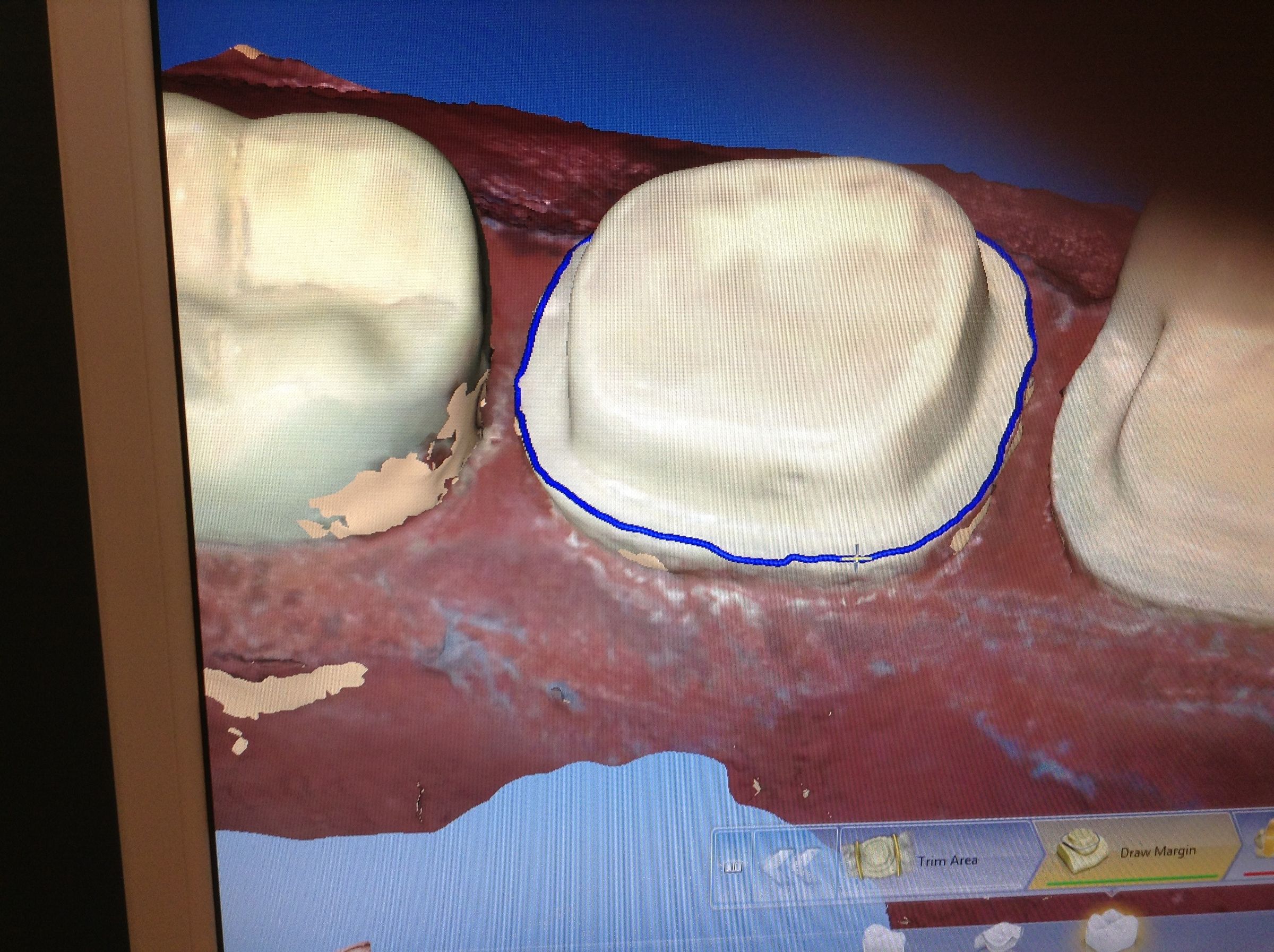 How to Fix a Tooth With CAD/CAM (CEREC)
