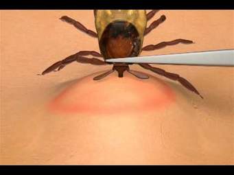 Removing a Tick - the Right Way!