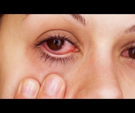 How to Instantly Relieve Itchy/Irritated Allergy Eyes!!