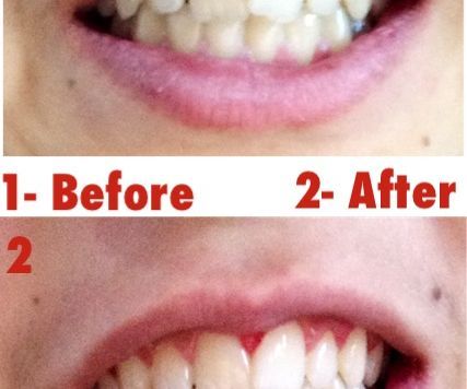 Make Your Teeth Whiter Than Snow