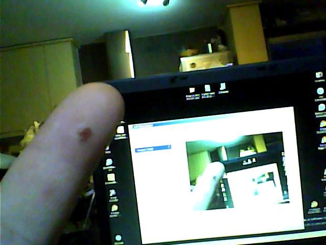 Wart Removal - 25minutes