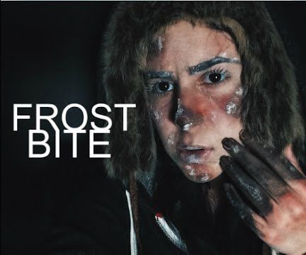 Frostbite