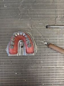 Remove Metal Teeth