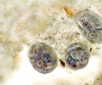 Understanding Everything About the Blastocystis Hominis