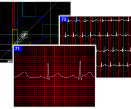 ECG Display With Arduino