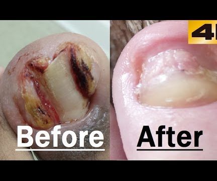 Ingrown Toenail FIX Before and After Removal