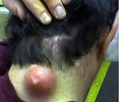 How to Kill Blind Pimples!!!