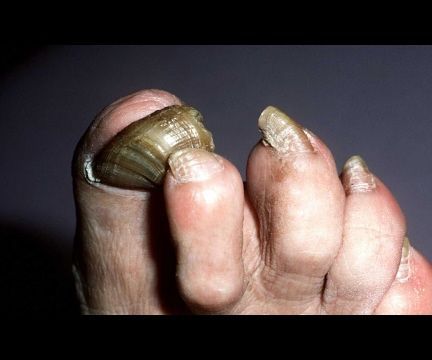 Cure for Nail Fungus - FASTEST Toenail Fungus Dissolver