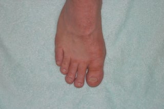 Foot Fungus Cure/Prevention
