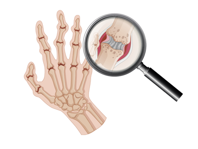 Assistive Technology to Meet the Basic Need to Eat for People With Arthritis