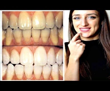 COME SBIANCARE I DENTI IN CASA