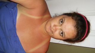 The Single Most Effective Way to Get Rid of a Sunburn