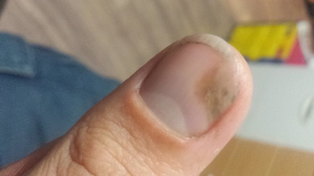 kezelés fungi nail urina