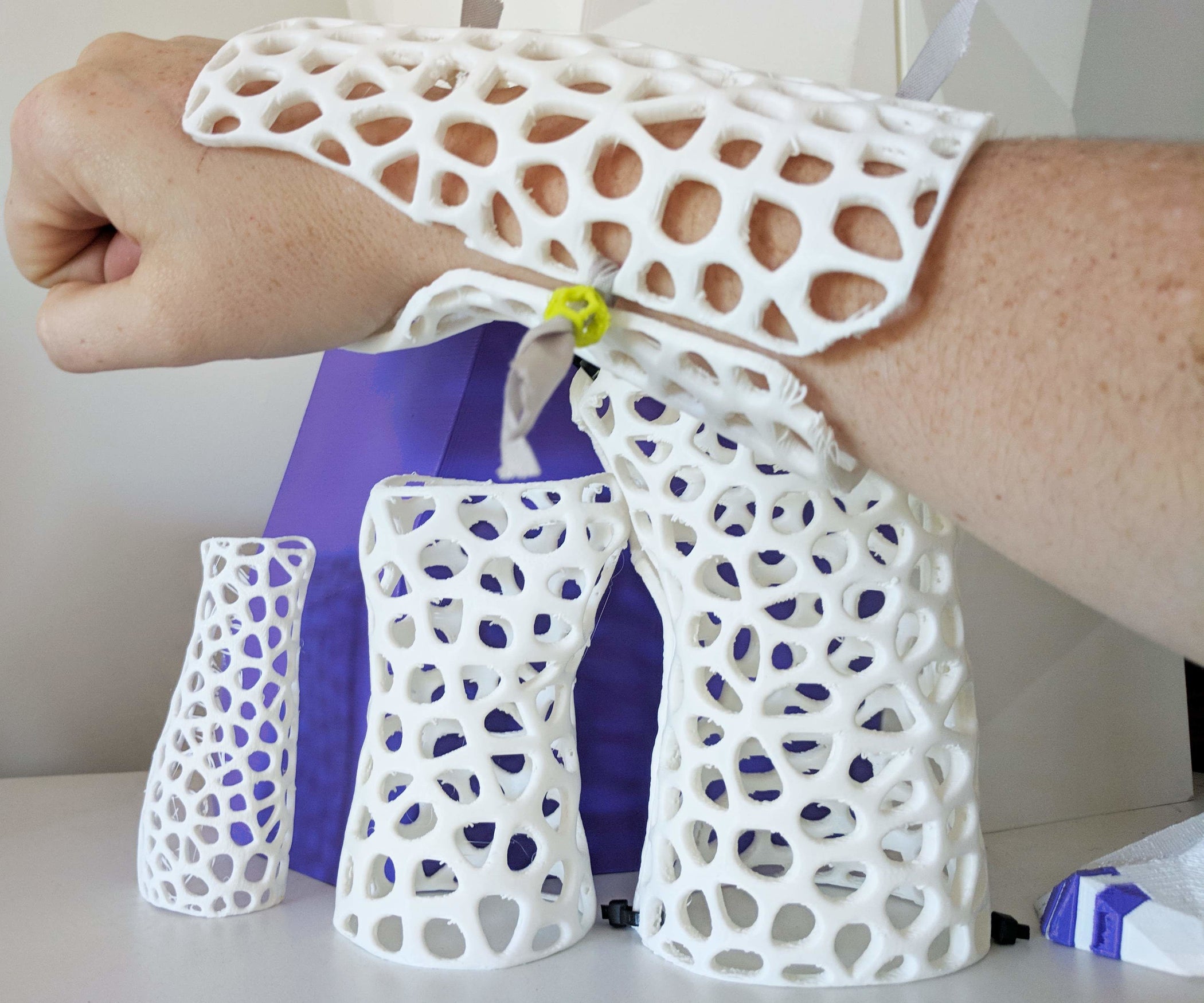 How to Design Custom, 3D Printable Braces for Arm Injury 8 Steps
