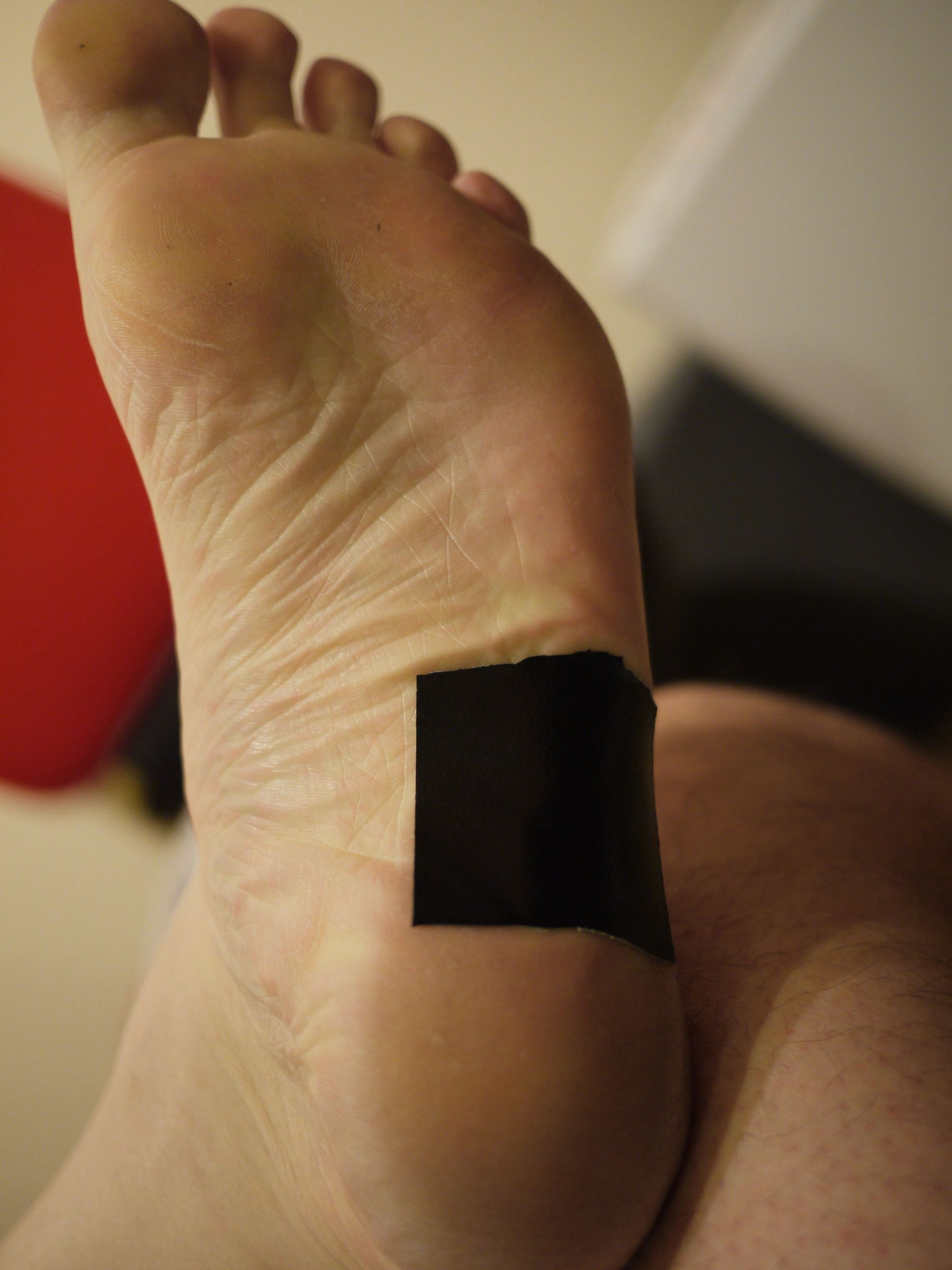 Effective Plantar Wart / Verruca Cure Using Duct Tape Occlusion Therapy